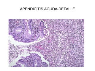 APENDICITIS AGUDA-DETALLE
 
