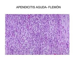APENDICITIS AGUDA- FLEMÓN
 
