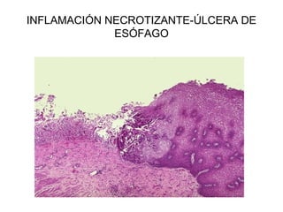 INFLAMACIÓN NECROTIZANTE-ÚLCERA DE
ESÓFAGO
 