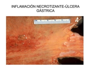 INFLAMACIÓN NECROTIZANTE-ÚLCERA
GÁSTRICA
 