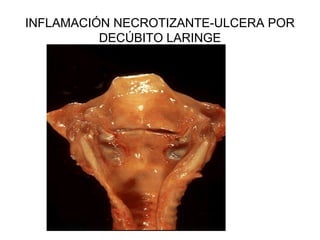 INFLAMACIÓN NECROTIZANTE-ULCERA POR
DECÚBITO LARINGE
 