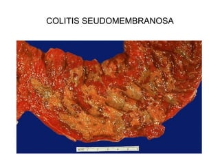 COLITIS SEUDOMEMBRANOSA
 
