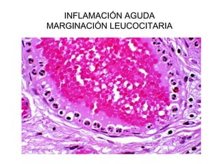INFLAMACIÓN AGUDA
MARGINACIÓN LEUCOCITARIA
 