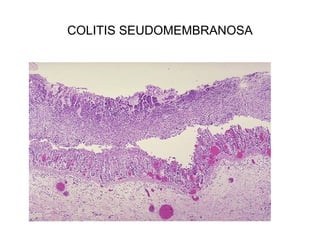 COLITIS SEUDOMEMBRANOSA
 