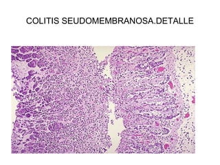 COLITIS SEUDOMEMBRANOSA.DETALLE
 