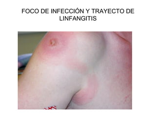 FOCO DE INFECCIÓN Y TRAYECTO DE
LINFANGITIS
 