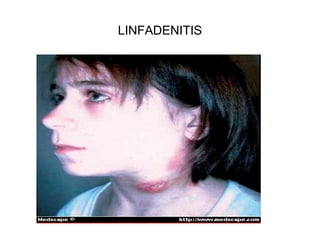LINFADENITIS
 