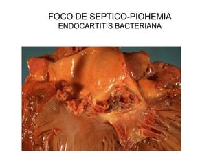 FOCO DE SEPTICO-PIOHEMIA
ENDOCARTITIS BACTERIANA
 