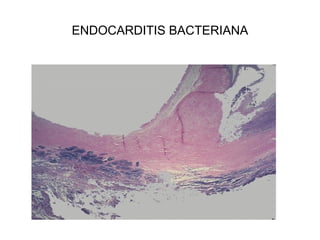 ENDOCARDITIS BACTERIANA
 