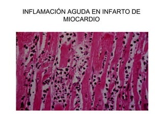 INFLAMACIÓN AGUDA EN INFARTO DE
MIOCARDIO
 