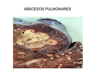 ABSCESOS PULMONARES
 