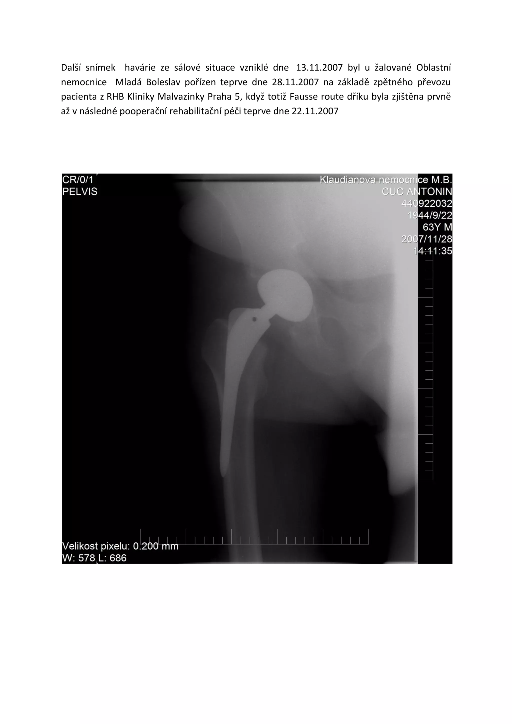 Další snímek havárie ze sálové situace vzniklé dne 13.11.2007 byl u žalované Oblastní
nemocnice Mladá Boleslav pořízen teprve dne 28.11.2007 na základě zpětného převozu
pacienta z RHB Kliniky Malvazinky Praha 5, když totiž Fausse route dříku byla zjištěna prvně
až v následné pooperační rehabilitační péči teprve dne 22.11.2007
 