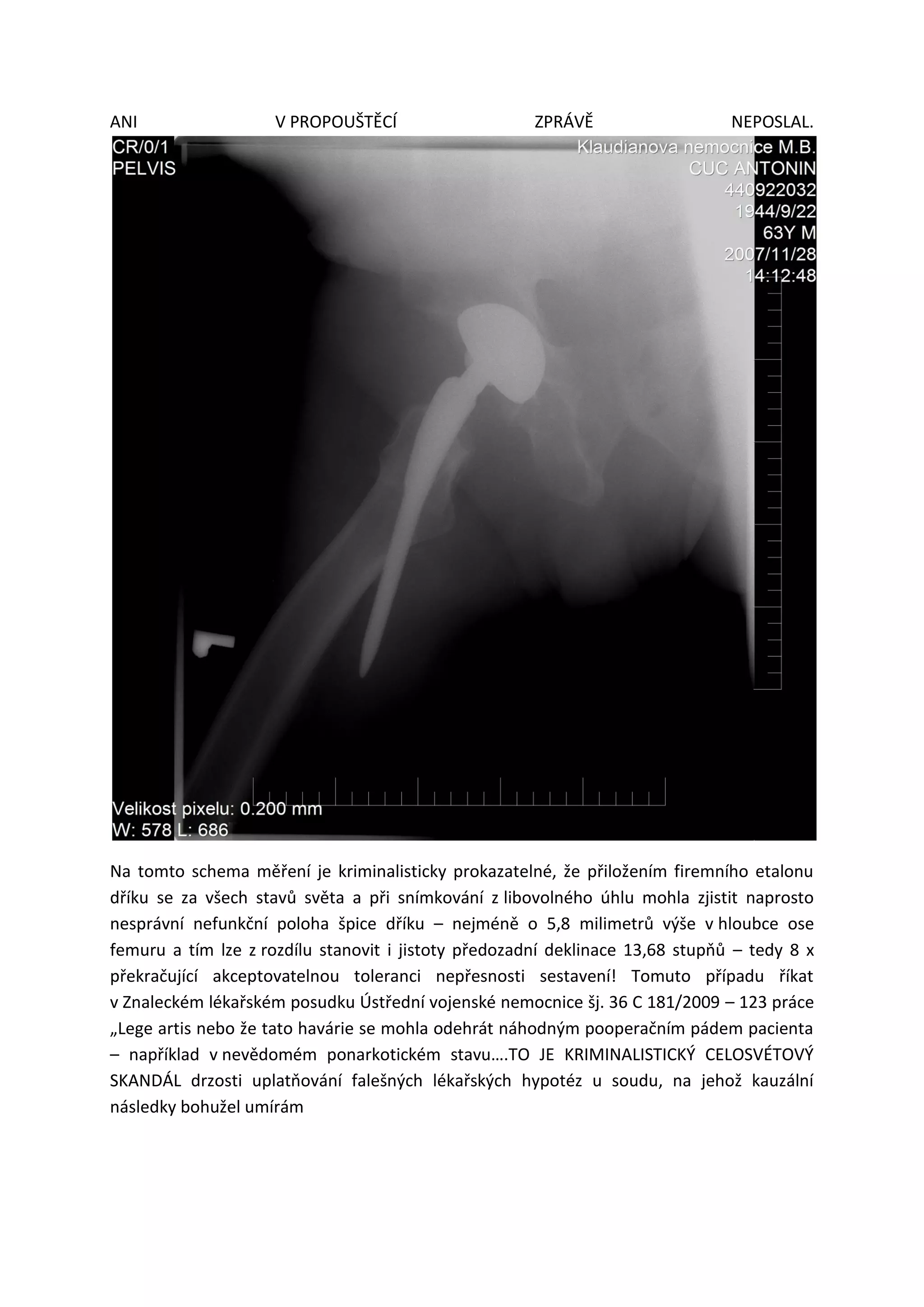 ANI V PROPOUŠTĚCÍ ZPRÁVĚ NEPOSLAL.
Na tomto schema měření je kriminalisticky prokazatelné, že přiložením firemního etalonu
dříku se za všech stavů světa a při snímkování z libovolného úhlu mohla zjistit naprosto
nesprávní nefunkční poloha špice dříku – nejméně o 5,8 milimetrů výše v hloubce ose
femuru a tím lze z rozdílu stanovit i jistoty předozadní deklinace 13,68 stupňů – tedy 8 x
překračující akceptovatelnou toleranci nepřesnosti sestavení! Tomuto případu říkat
v Znaleckém lékařském posudku Ústřední vojenské nemocnice šj. 36 C 181/2009 – 123 práce
„Lege artis nebo že tato havárie se mohla odehrát náhodným pooperačním pádem pacienta
– například v nevědomém ponarkotickém stavu….TO JE KRIMINALISTICKÝ CELOSVÉTOVÝ
SKANDÁL drzosti uplatňování falešných lékařských hypotéz u soudu, na jehož kauzální
následky bohužel umírám
 