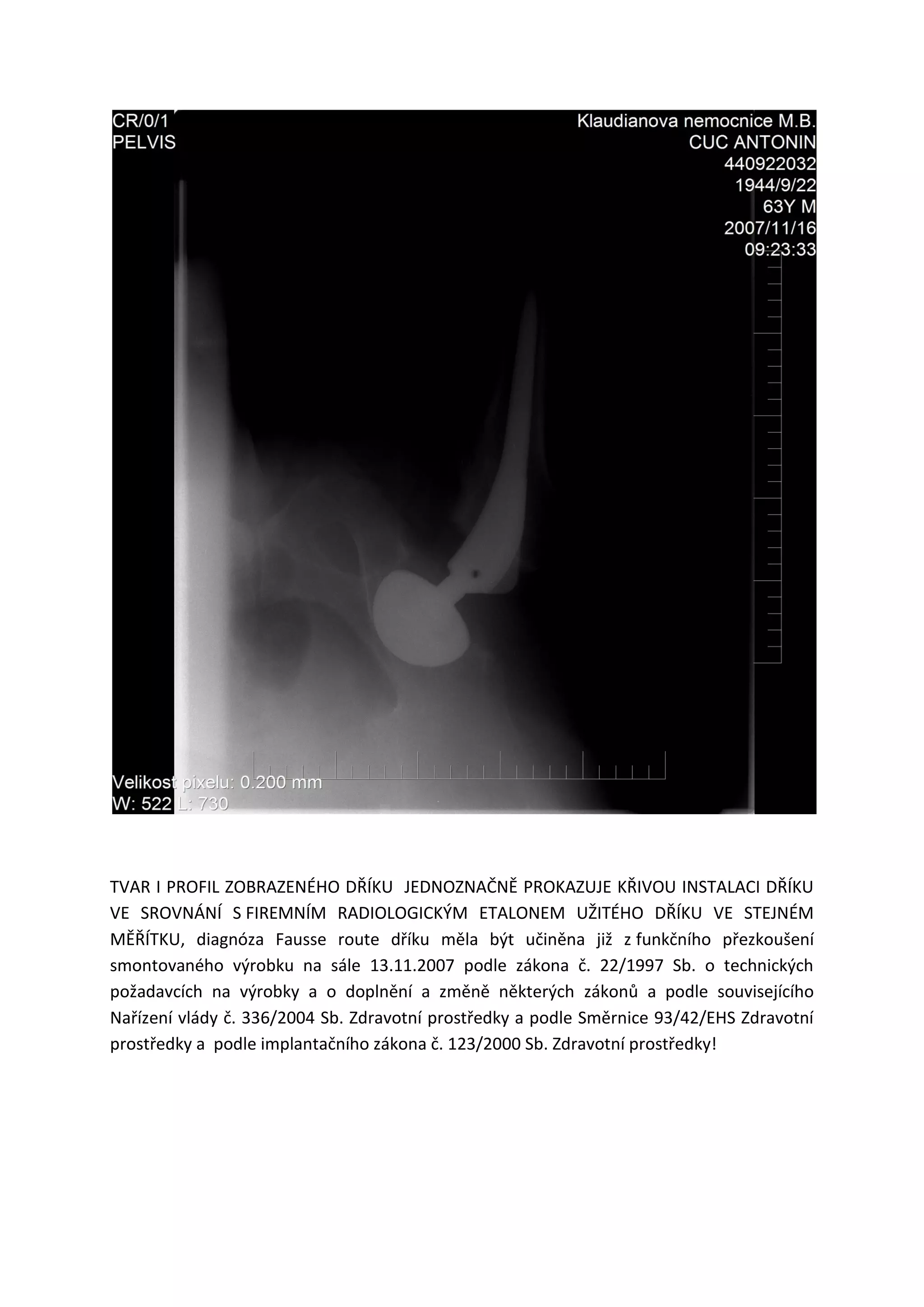 TVAR I PROFIL ZOBRAZENÉHO DŘÍKU JEDNOZNAČNĚ PROKAZUJE KŘIVOU INSTALACI DŘÍKU
VE SROVNÁNÍ S FIREMNÍM RADIOLOGICKÝM ETALONEM UŽITÉHO DŘÍKU VE STEJNÉM
MĚŘÍTKU, diagnóza Fausse route dříku měla být učiněna již z funkčního přezkoušení
smontovaného výrobku na sále 13.11.2007 podle zákona č. 22/1997 Sb. o technických
požadavcích na výrobky a o doplnění a změně některých zákonů a podle souvisejícího
Nařízení vlády č. 336/2004 Sb. Zdravotní prostředky a podle Směrnice 93/42/EHS Zdravotní
prostředky a podle implantačního zákona č. 123/2000 Sb. Zdravotní prostředky!
 