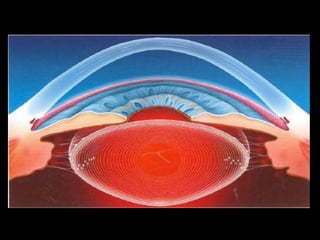cataract.pptx