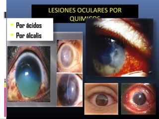LESIONES OCULARES POR
QUIMICOS
 Por ácidosPor ácidos
 Por álcalisPor álcalis
 