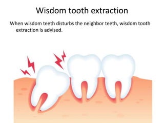 Wisdom tooth extraction
When wisdom teeth disturbs the neighbor teeth, wisdom tooth
extraction is advised.
 