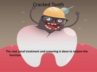 Cracked Tooth
The root canal treatment and crowning is done to restore the
function.
 