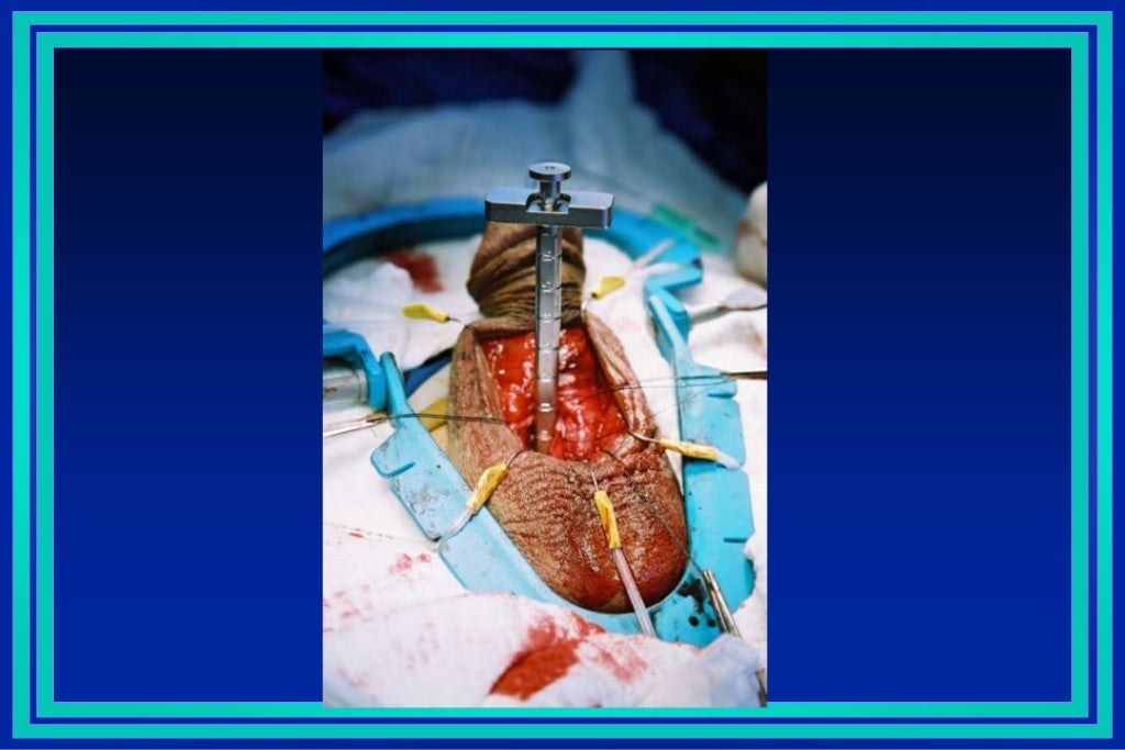 Como é Feita A Cirurgia De Prótese Peniana Como fazer implante de prótese peniana