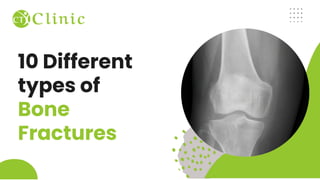 10 Different
types of
Bone
Fractures
 