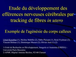 Etude du développement des
efférences nerveuses cérébrales par
tracking de fibres in utero
Exemple de l'agénésie du corps calleux
Lbiati Kaouthar (1), Mylène Mabille (2), Odile Plaisant (1), René Frydman (2),
Vincent Delmas (1), Dominique Musset (2), Olivier Ami (1) (2)
1-Unité de Recherche en Développement, Imagerie et Anatomie (URDIA) -
Université Paris Descartes
2-APHP, Hôpital Antoine Béclère, 92140 Clamart
 
