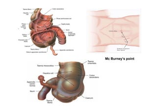 Mc Burney s point




                    12
 
