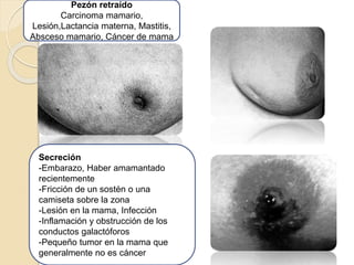 Pezón retraído
Carcinoma mamario,
Lesión,Lactancia materna, Mastitis,
Absceso mamario, Cáncer de mama
Secreción
-Embarazo, Haber amamantado
recientemente
-Fricción de un sostén o una
camiseta sobre la zona
-Lesión en la mama, Infección
-Inflamación y obstrucción de los
conductos galactóforos
-Pequeño tumor en la mama que
generalmente no es cáncer
 