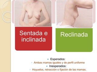 Sentada e
inclinada
Reclinada
 Esperados:
◦ Ambas mamas iguales y de perfil uniforme
 Inesperados:
◦ Hoyuelos, retracción o fijación de las mamas.
 