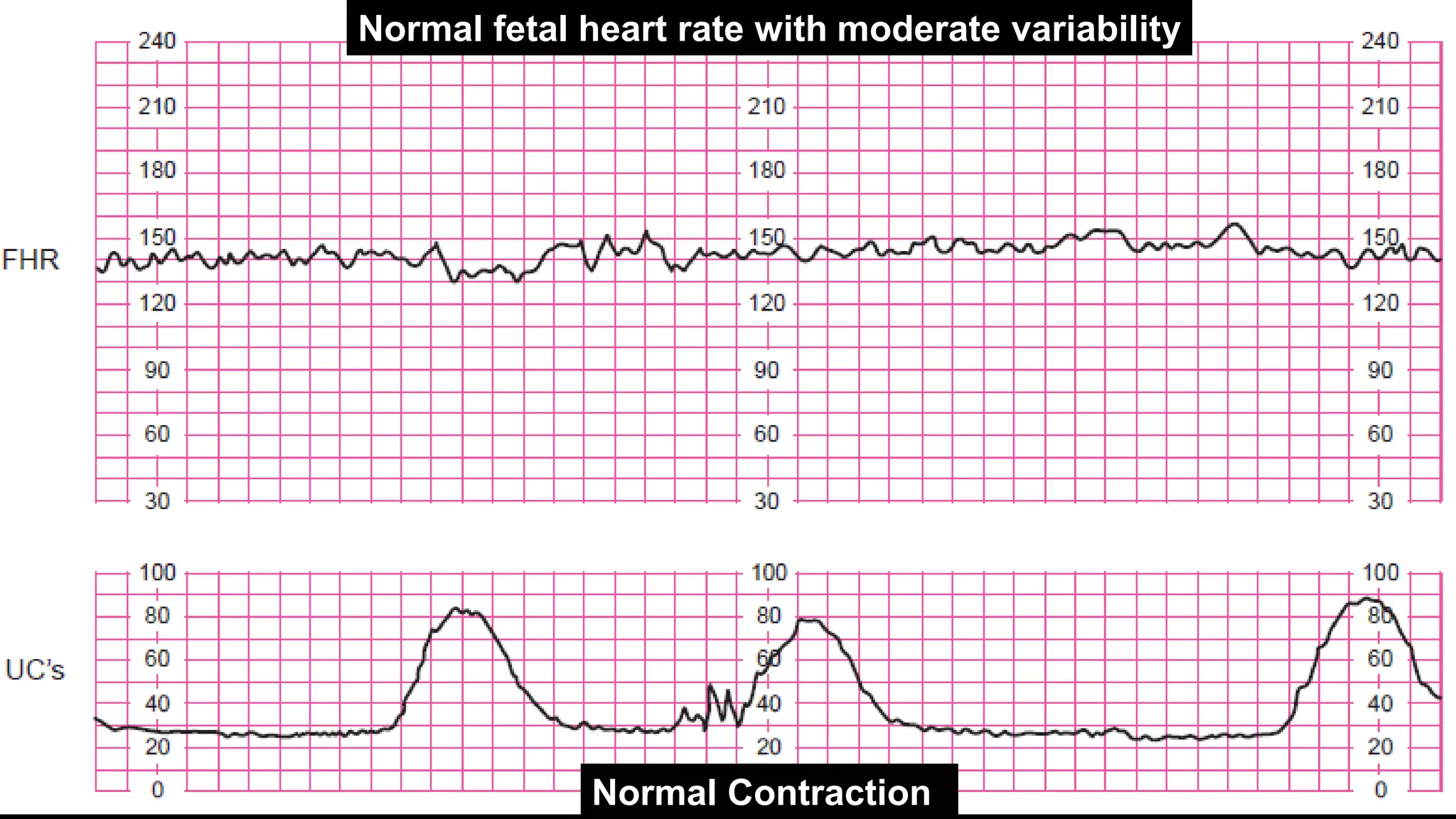Fetal assessment | PPTX