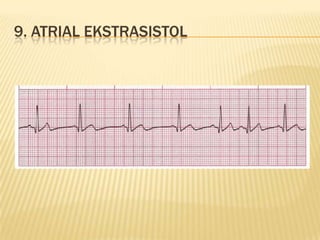 9. ATRIAL EKSTRASISTOL
 