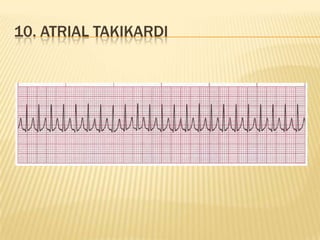 10. ATRIAL TAKIKARDI
 