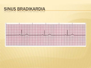 SINUS BRADIKARDIA
 