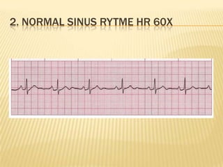 2. NORMAL SINUS RYTME HR 60X
 