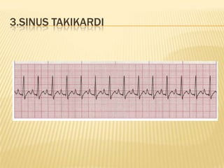 3.SINUS TAKIKARDI
 