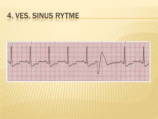 4. VES. SINUS RYTME
 