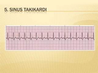 5. SINUS TAKIKARDI
 