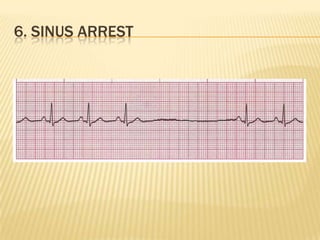 6. SINUS ARREST
 
