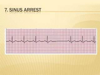 7. SINUS ARREST
 