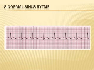 8.NORMAL SINUS RYTME
 