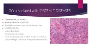  GRANULOMATOUS DISEASES
 WEGENER’S GRANULOMATOSIS
 ETIOLOGY: immunologically mediated tissue injury
 HISTOPATHOLOGY:
- scattered giant cells
- foci of acute inflammation
- micro-abscesses covered by a thin, acanthotic epithelium
- Vascular changes-- small size of the gingival blood vessels
GO associated with SYSTEMIC DISEASES
 