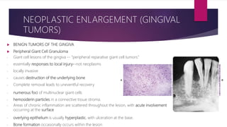  BENIGN TUMORS OF THE GINGIVA
 Peripheral Giant Cell Granuloma
‐ Giant cell lesions of the gingiva -- “peripheral reparative giant cell tumors.”
‐ essentially responses to local injury--not neoplasms
‐ locally invasive
‐ causes destruction of the underlying bone
‐ Complete removal leads to uneventful recovery
‐ numerous foci of multinuclear giant cells
‐ hemosiderin particles in a connective tissue stroma.
‐ Areas of chronic inflammation are scattered throughout the lesion, with acute involvement
occurring at the surface
‐ overlying epithelium is usually hyperplastic, with ulceration at the base.
‐ Bone formation occasionally occurs within the lesion
NEOPLASTIC ENLARGEMENT (GINGIVAL
TUMORS)
 