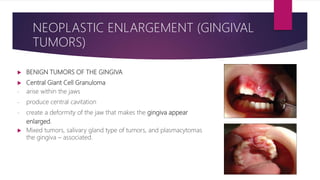  BENIGN TUMORS OF THE GINGIVA
 Central Giant Cell Granuloma
- arise within the jaws
- produce central cavitation
- create a deformity of the jaw that makes the gingiva appear
enlarged.
 Mixed tumors, salivary gland type of tumors, and plasmacytomas
the gingiva – associated.
NEOPLASTIC ENLARGEMENT (GINGIVAL
TUMORS)
 