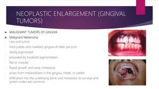  MALIGNANT TUMORS OF GINGIVA
 Malignant Melanoma
- rare oral tumor
- hard palate and maxillary gingiva of older persons
- darkly pigmented
- preceded by localized pigmentation
- flat or nodular
- Rapid growth and early metastasis
- arises from melanoblasts in the gingiva, cheek, or palate.
- Infiltration into the underlying bone and metastasis to cervical and
lymph nodes are common
NEOPLASTIC ENLARGEMENT (GINGIVAL
TUMORS)
 