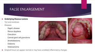 FALSE ENLARGEMENT
 Underlying Osseous Lesions
- Tori and exostoses
- Diseases:
‐ Paget's disease
‐ fibrous dysplasia
‐ Cherubism
‐ Central giant cell granuloma
‐ Ameloblastoma
‐ Osteoma
‐ Osteosarcoma
 Gingival tissue can appear normal or may have unrelated inflammatory changes
 