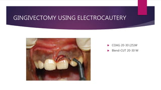 GINGIVECTOMY USING ELECTROCAUTERY
 COAG 20-30 (25)W
 Blend-CUT 20-30 W
 