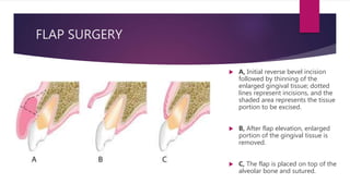 FLAP SURGERY
 A, Initial reverse bevel incision
followed by thinning of the
enlarged gingival tissue; dotted
lines represent incisions, and the
shaded area represents the tissue
portion to be excised.
 B, After flap elevation, enlarged
portion of the gingival tissue is
removed.
 C, The flap is placed on top of the
alveolar bone and sutured.
 