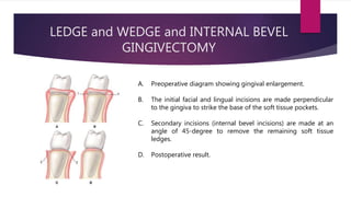 LEDGE and WEDGE and INTERNAL BEVEL
GINGIVECTOMY
A. Preoperative diagram showing gingival enlargement.
B. The initial facial and lingual incisions are made perpendicular
to the gingiva to strike the base of the soft tissue pockets.
C. Secondary incisions (internal bevel incisions) are made at an
angle of 45-degree to remove the remaining soft tissue
ledges.
D. Postoperative result.
 