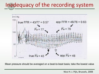 PCI & AimRadial 2018 | Pitfalls in coronary pressure assessment - Zsolt ...