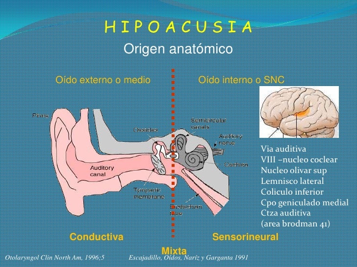Resultado de imagen para hipoacusia