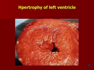 Hpertrophy of left ventricle 